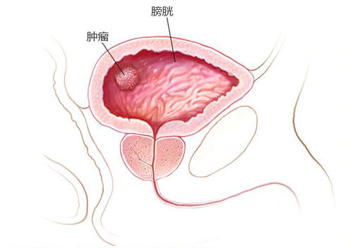 福州膀胱癌治疗怎么预防复发