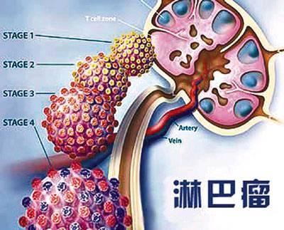 福州哪里看淋巴癌比较专业