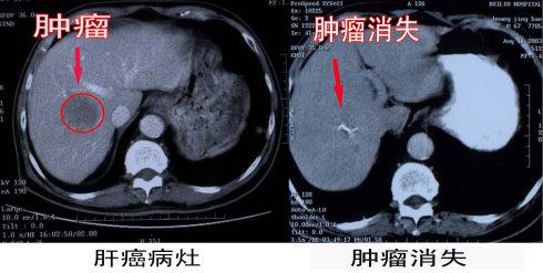 福州治疗肝癌好的医院排名