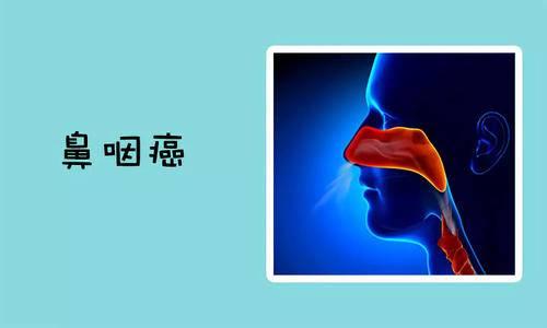 福州御和堂：鼻咽癌需要注意哪些异常