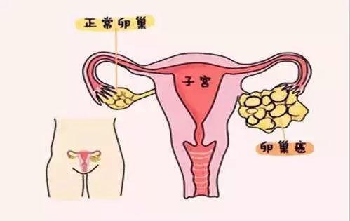 卵巢癌常见的发病的原因