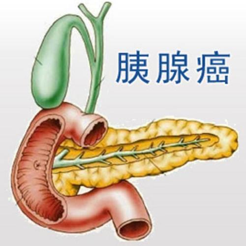 胰腺癌的高危因素有哪些