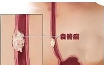 食道癌晚期症状是什么？晚期还能治好吗？